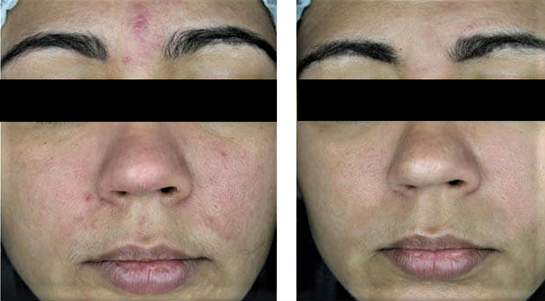 Kjemisk Peeling Apame